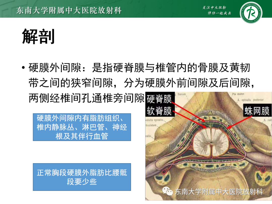 【PPT】椎管内硬膜外脂肪增多症-3