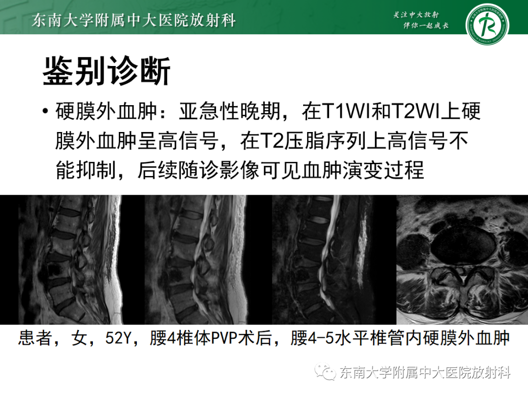 【PPT】椎管内硬膜外脂肪增多症-16