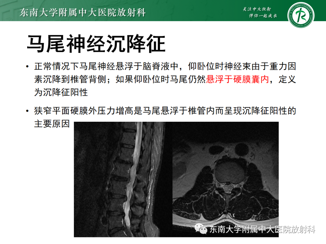 【PPT】椎管内硬膜外脂肪增多症-13