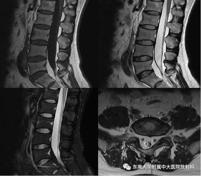 椎管内硬膜外脂肪增多症