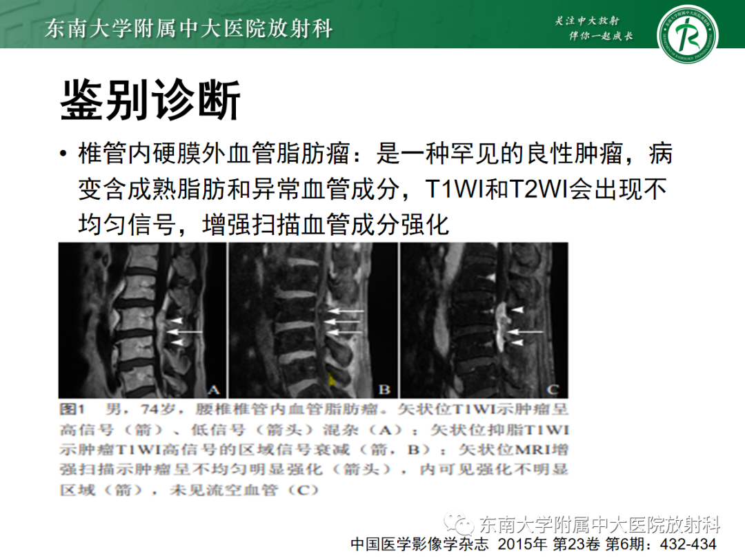 【PPT】椎管内硬膜外脂肪增多症-15