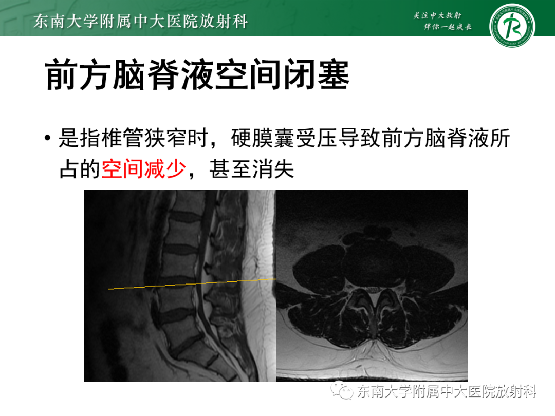 【PPT】椎管内硬膜外脂肪增多症-14