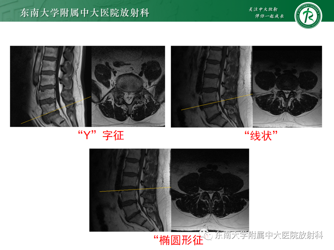 【PPT】椎管内硬膜外脂肪增多症-10