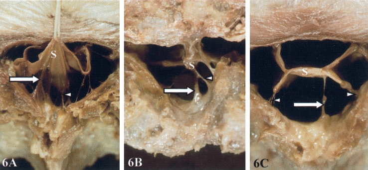 常见易忽略的疾病—椎管内硬膜外脂肪增多症-14