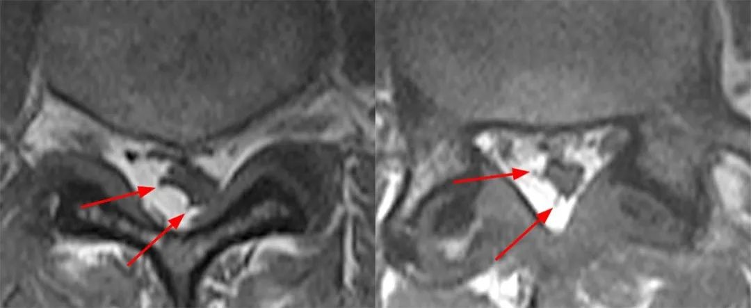 常见易忽略的疾病—椎管内硬膜外脂肪增多症-12