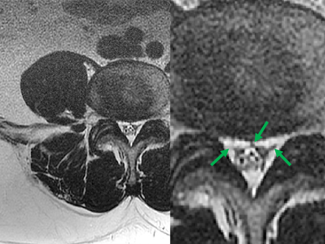 常见易忽略的疾病—椎管内硬膜外脂肪增多症-16