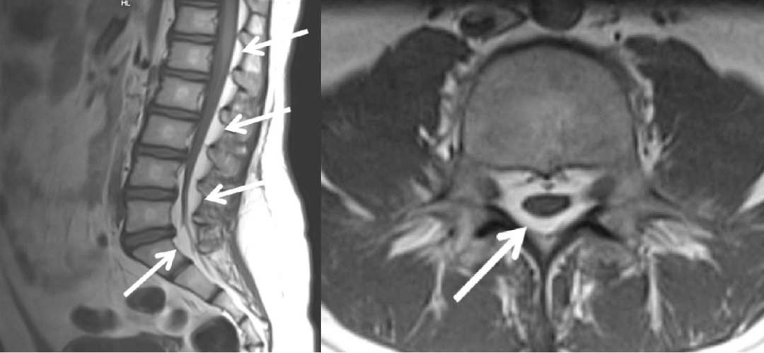 常见易忽略的疾病—椎管内硬膜外脂肪增多症-1