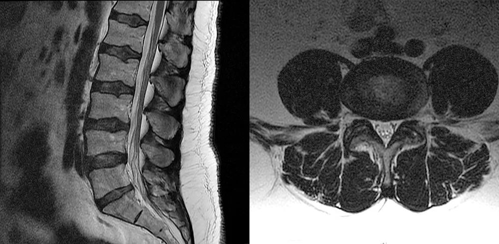 常见易忽略的疾病—椎管内硬膜外脂肪增多症-1