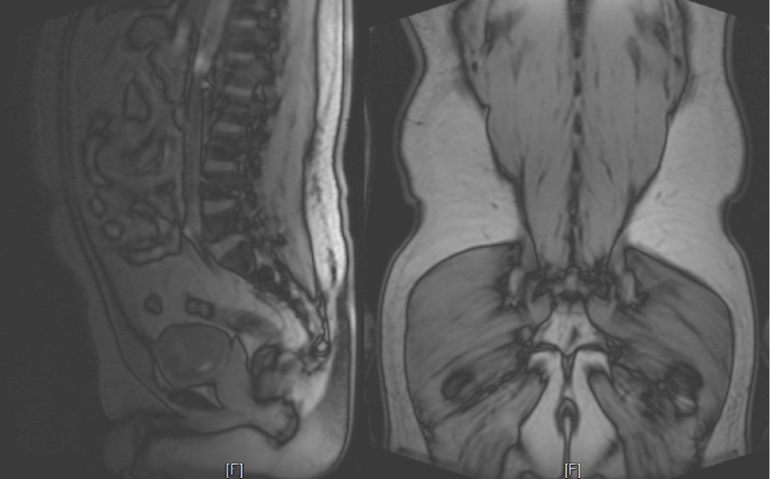 常见易忽略的疾病—椎管内硬膜外脂肪增多症-3