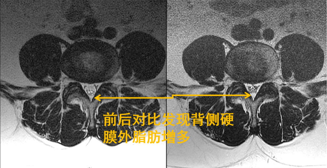 常见易忽略的疾病—椎管内硬膜外脂肪增多症-9
