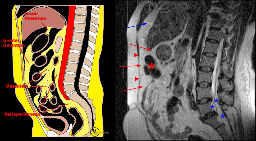 常见易忽略的疾病—椎管内硬膜外脂肪增多症-19