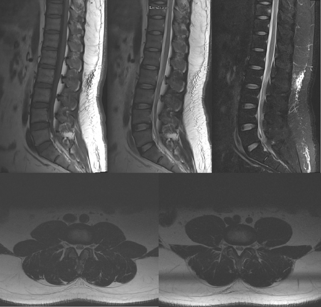 常见易忽略的疾病—椎管内硬膜外脂肪增多症-5