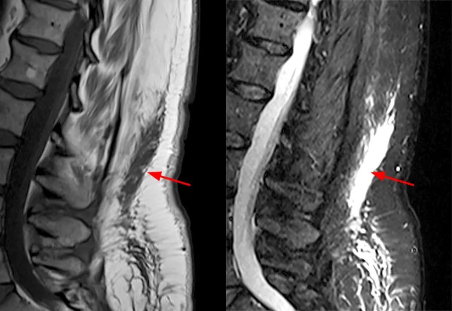 常见易忽略的疾病—椎管内硬膜外脂肪增多症-7
