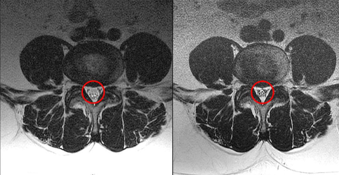 常见易忽略的疾病—椎管内硬膜外脂肪增多症-2