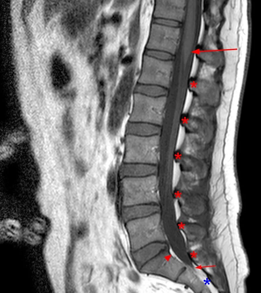 常见易忽略的疾病—椎管内硬膜外脂肪增多症-7
