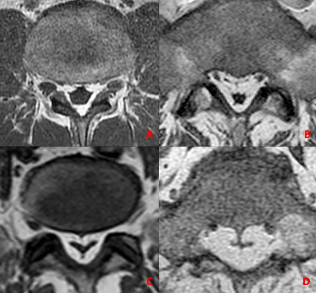 常见易忽略的疾病—椎管内硬膜外脂肪增多症-11