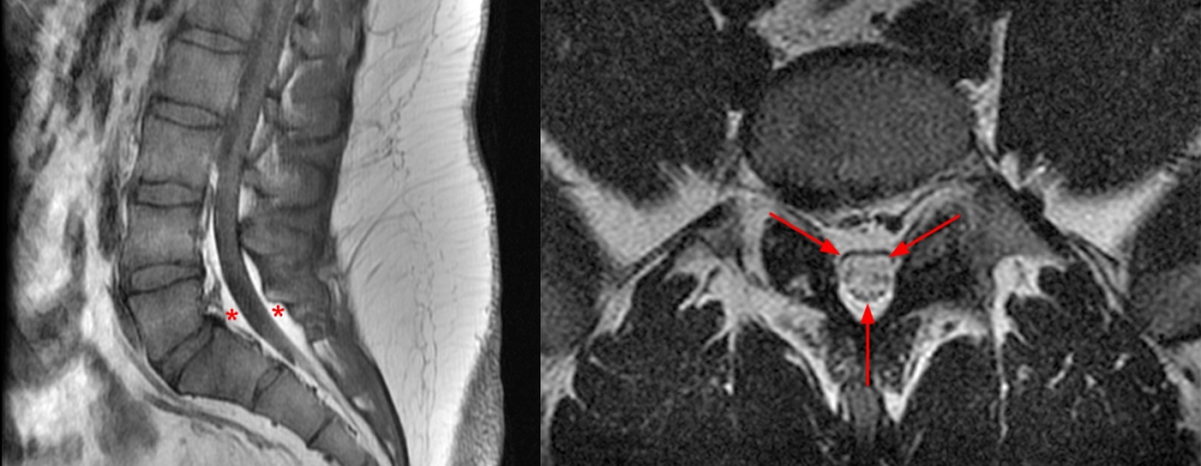 常见易忽略的疾病—椎管内硬膜外脂肪增多症-17