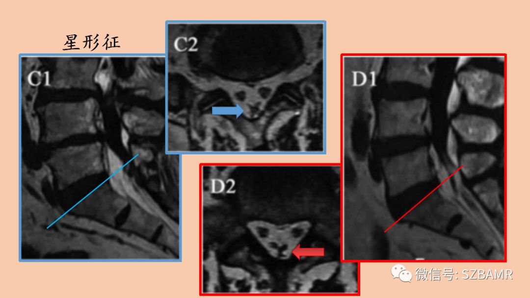 椎管内硬膜外脂肪增多症与终丝脂肪沉积 椎管内硬膜外脂肪增多症与终丝脂肪沉积