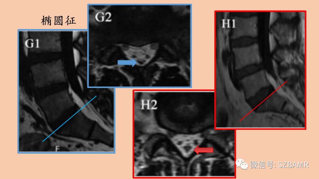 椎管内硬膜外脂肪增多症与终丝脂肪沉积 椎管内硬膜外脂肪增多症与终丝脂肪沉积