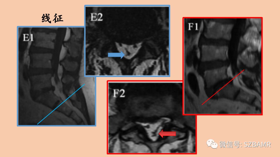椎管内硬膜外脂肪增多症与终丝脂肪沉积 椎管内硬膜外脂肪增多症与终丝脂肪沉积