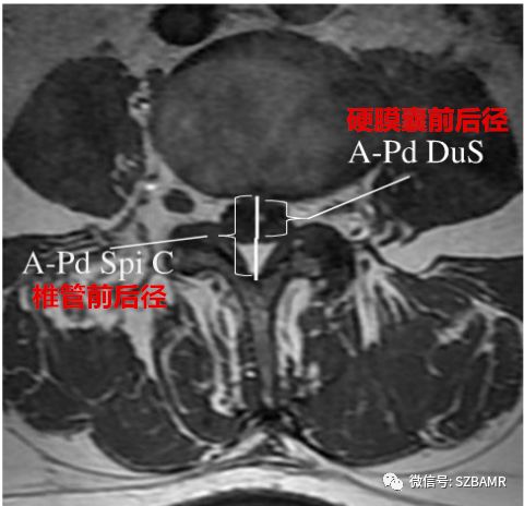 椎管内硬膜外脂肪增多症与终丝脂肪沉积 椎管内硬膜外脂肪增多症与终丝脂肪沉积