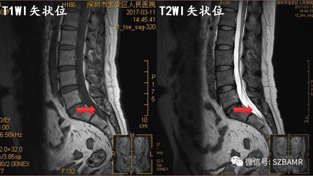 椎管内硬膜外脂肪增多症与终丝脂肪沉积 椎管内硬膜外脂肪增多症与终丝脂肪沉积