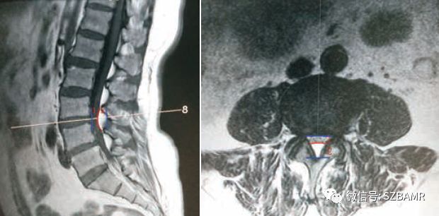 椎管内硬膜外脂肪增多症与终丝脂肪沉积