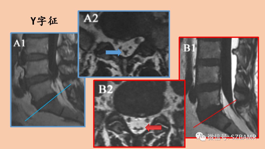 椎管内硬膜外脂肪增多症与终丝脂肪沉积 椎管内硬膜外脂肪增多症与终丝脂肪沉积