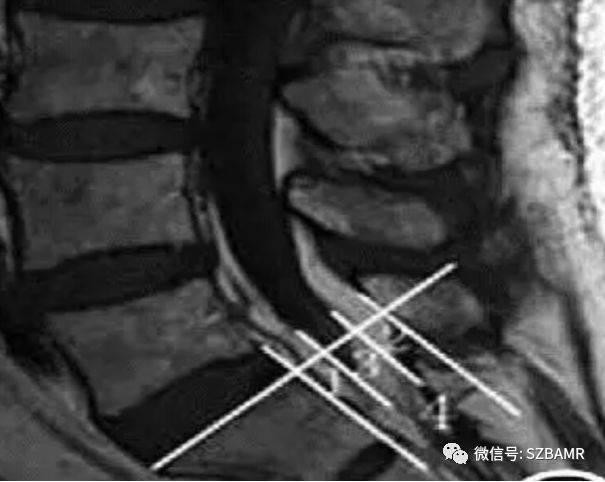 椎管内硬膜外脂肪增多症与终丝脂肪沉积 椎管内硬膜外脂肪增多症与终丝脂肪沉积
