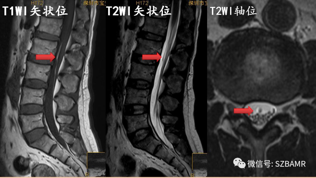 椎管内硬膜外脂肪增多症与终丝脂肪沉积 椎管内硬膜外脂肪增多症与终丝脂肪沉积