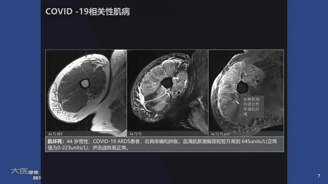 【PPT】COVID-19 的肌肉骨骼表现：对目前所描述的多模态成像及临床症状的图片综述​-5