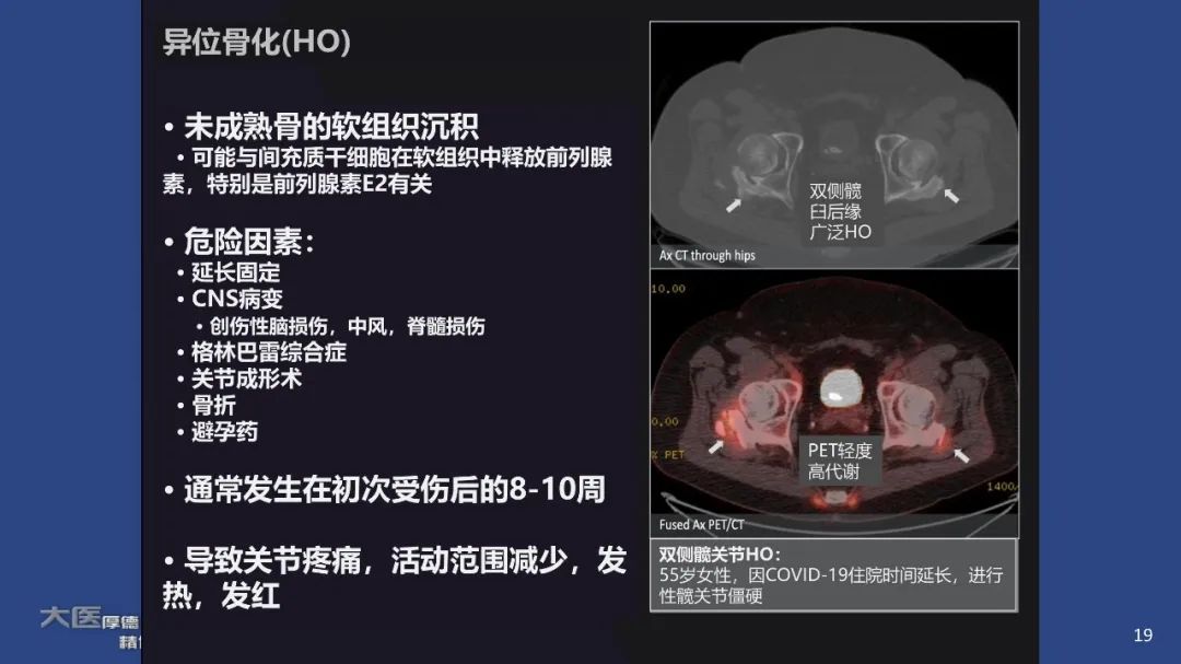 【PPT】COVID-19 的肌肉骨骼表现：对目前所描述的多模态成像及临床症状的图片综述​-19