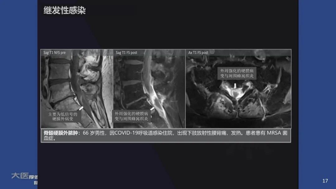 【PPT】COVID-19 的肌肉骨骼表现：对目前所描述的多模态成像及临床症状的图片综述​-15