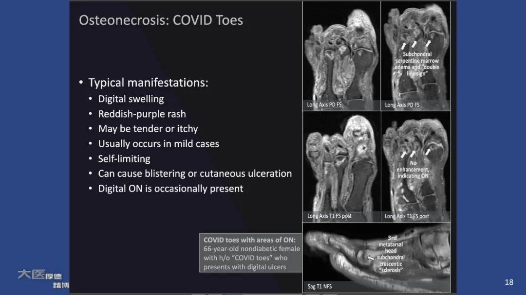 【PPT】COVID-19 的肌肉骨骼表现：对目前所描述的多模态成像及临床症状的图片综述​-18
