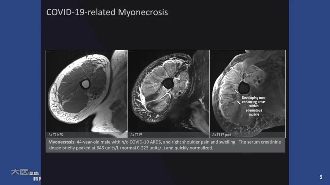 【PPT】COVID-19 的肌肉骨骼表现：对目前所描述的多模态成像及临床症状的图片综述​-6