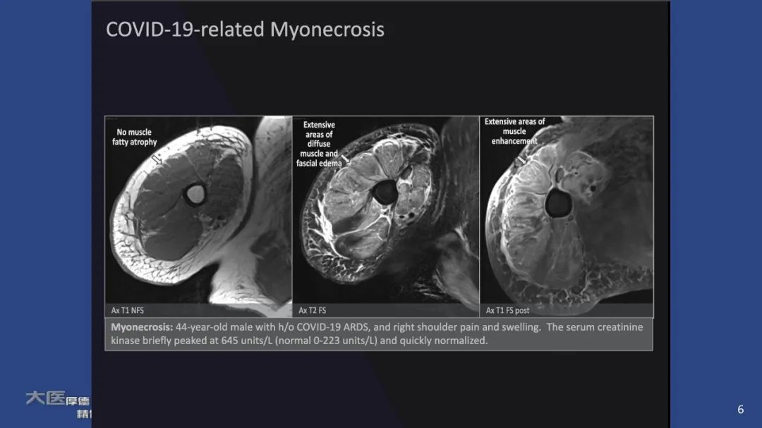 【PPT】COVID-19 的肌肉骨骼表现：对目前所描述的多模态成像及临床症状的图片综述​-4