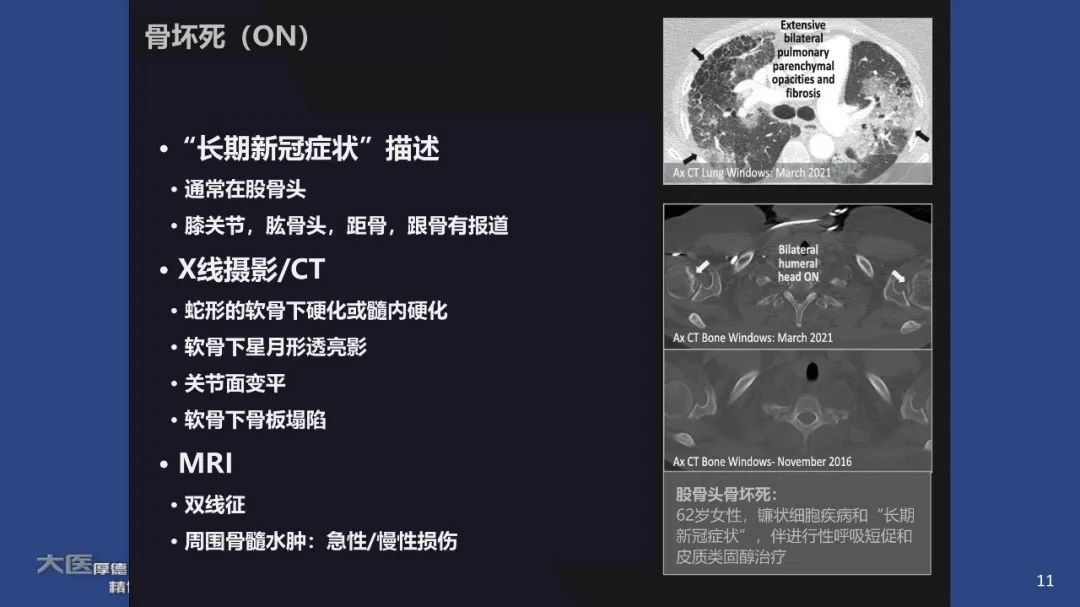 【PPT】COVID-19 的肌肉骨骼表现：对目前所描述的多模态成像及临床症状的图片综述​-11