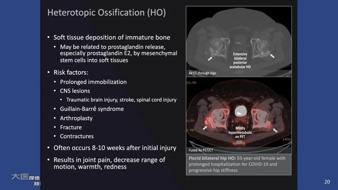 【PPT】COVID-19 的肌肉骨骼表现：对目前所描述的多模态成像及临床症状的图片综述​-20