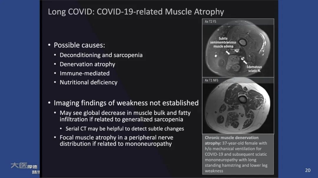 【PPT】COVID-19 的肌肉骨骼表现：对目前所描述的多模态成像及临床症状的图片综述​-18