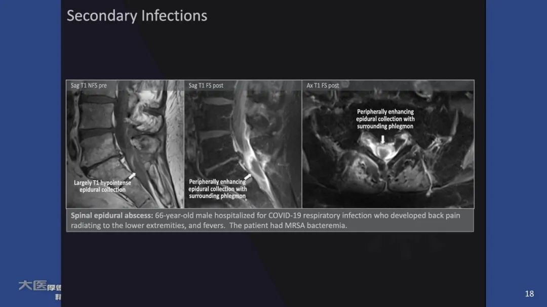【PPT】COVID-19 的肌肉骨骼表现：对目前所描述的多模态成像及临床症状的图片综述​-16
