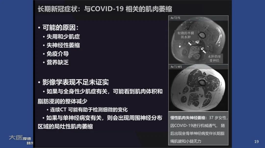 【PPT】COVID-19 的肌肉骨骼表现：对目前所描述的多模态成像及临床症状的图片综述​-17