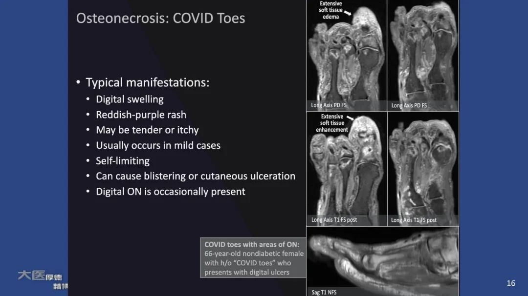 【PPT】COVID-19 的肌肉骨骼表现：对目前所描述的多模态成像及临床症状的图片综述​-16