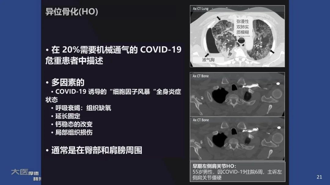 【PPT】COVID-19 的肌肉骨骼表现：对目前所描述的多模态成像及临床症状的图片综述​-21