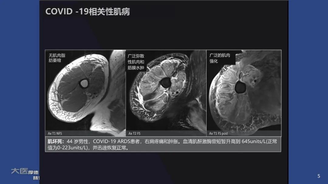 【PPT】COVID-19 的肌肉骨骼表现：对目前所描述的多模态成像及临床症状的图片综述​-3