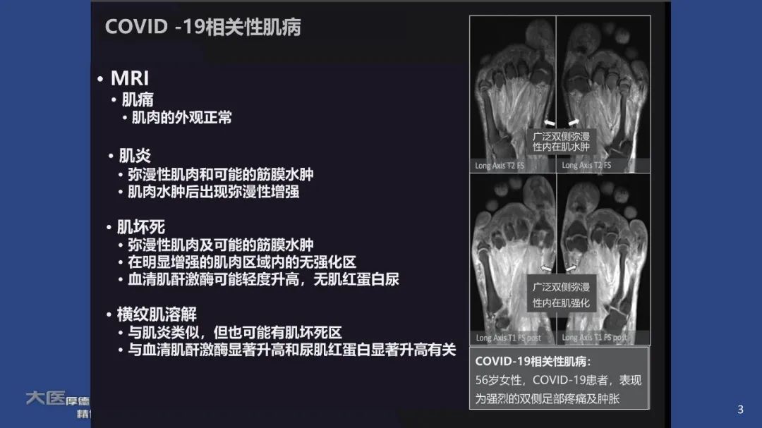 【PPT】COVID-19 的肌肉骨骼表现：对目前所描述的多模态成像及临床症状的图片综述​-1