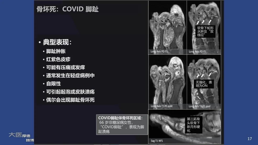 【PPT】COVID-19 的肌肉骨骼表现：对目前所描述的多模态成像及临床症状的图片综述​-17