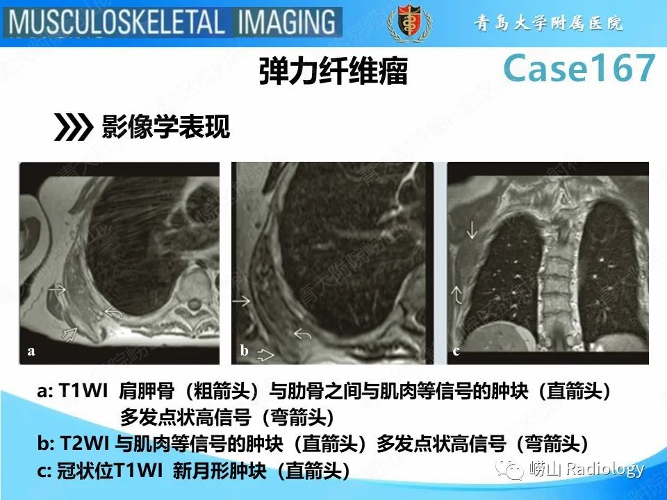 【PPT】背部弹力纤维瘤-16