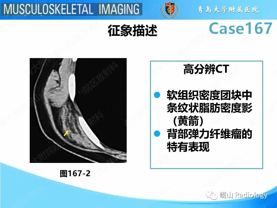 【PPT】背部弹力纤维瘤-18
