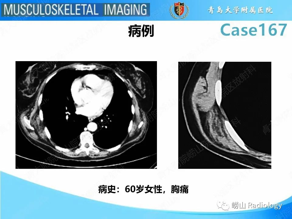 【PPT】背部弹力纤维瘤-2