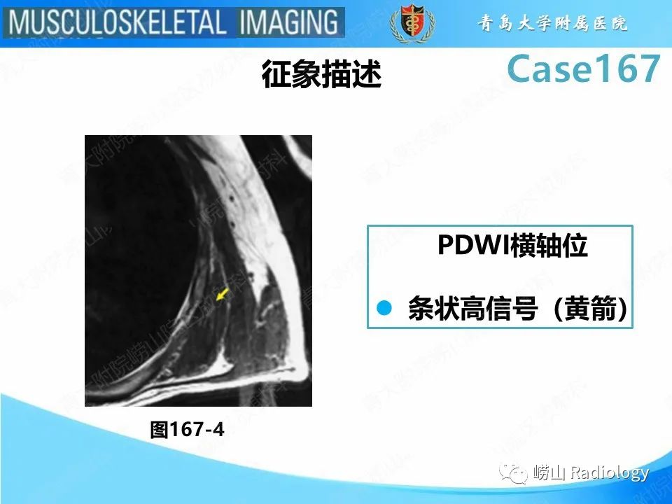 【PPT】背部弹力纤维瘤-20